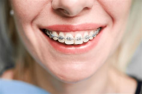 ortodoncia brackets metalicos|what are brackets in braces.